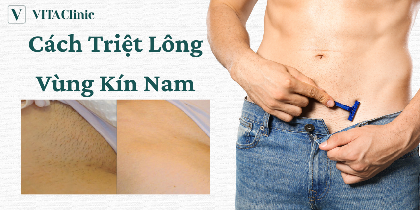 Triệt Lông Vùng Kín Cho Nam: Tự Tin Khám Phá Bản Thân Một Cách An Toàn