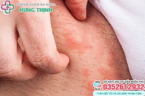 Vì Sao Ngứa Vùng Kín? Hiểu Đúng Để Chăm Sóc Đúng Cách!