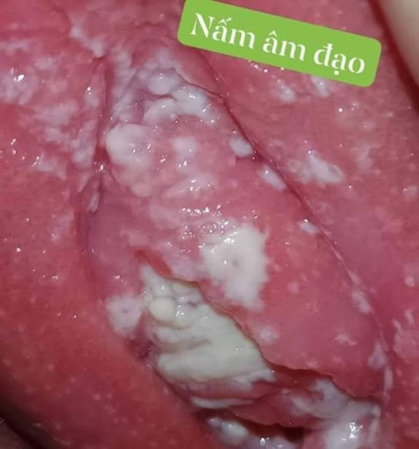 Vì Sao Ngứa Vùng Kín? Hiểu Đúng Để Chăm Sóc Đúng Cách!