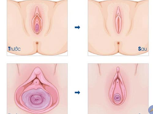 Vùng kín bị rộng: Hiểu đúng để tự tin và yêu thương cơ thể mình