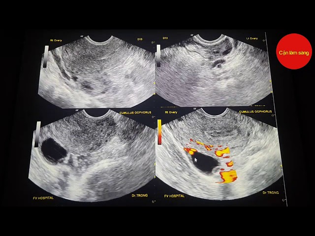Trứng Đã Rụng Siêu Âm Có Thấy Không? Giải Mã Chu Trình Thụ Thai