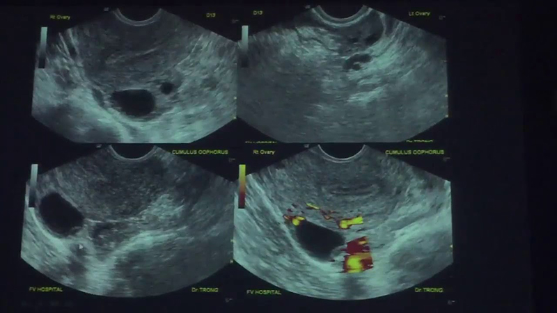 Trứng Đã Rụng Siêu Âm Có Thấy Không? Giải Mã Chu Trình Thụ Thai