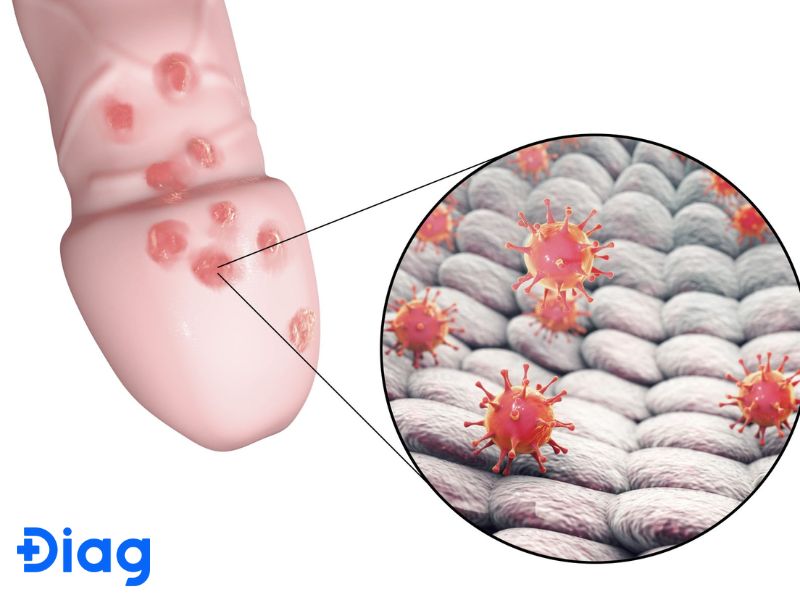 Làm Sao Để Nhận Biết **Triệu Chứng Mụn Rộp Sinh Dục** Sớm Nhất?