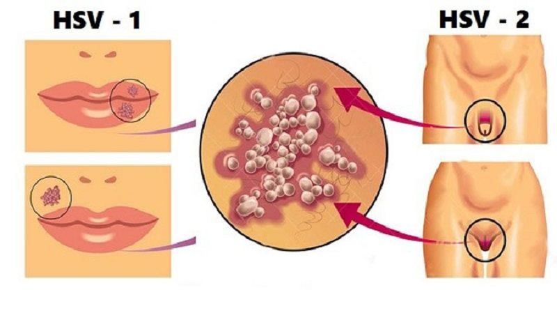 Làm Sao Để Nhận Biết **Triệu Chứng Mụn Rộp Sinh Dục** Sớm Nhất?