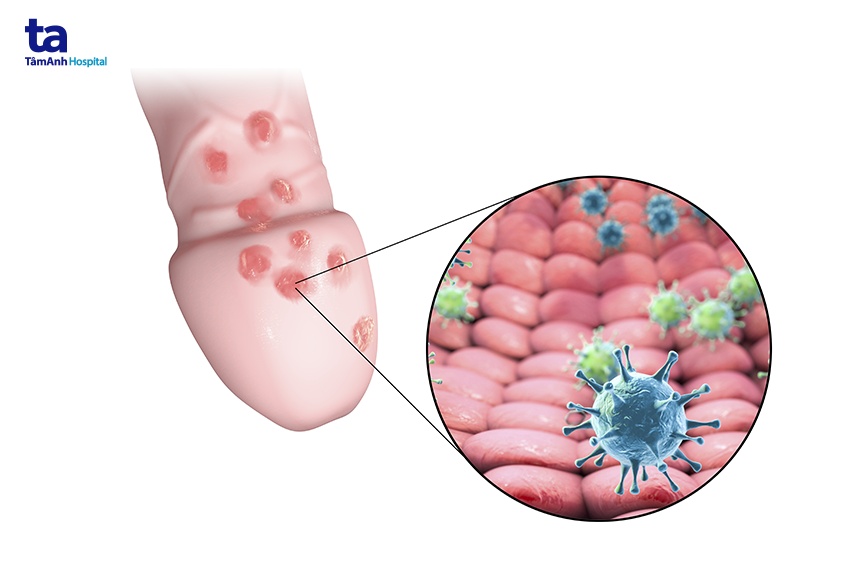 Làm Sao Để Nhận Biết **Triệu Chứng Mụn Rộp Sinh Dục** Sớm Nhất?