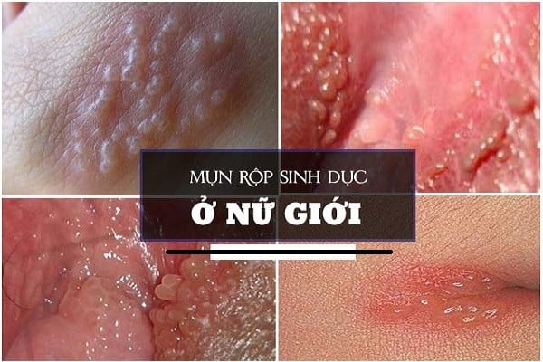 Làm Sao Để Nhận Biết **Triệu Chứng Mụn Rộp Sinh Dục** Sớm Nhất?